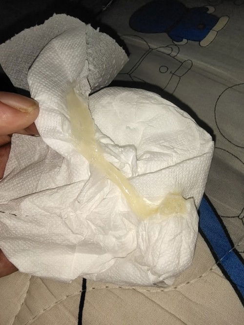 ขอโทษนะคะกับรูปภาพ
มีอั่นนี้ออกมาแต่ไม่มีอาการอะไรเลย
ท้องได้ 36+3 แล้วคะ