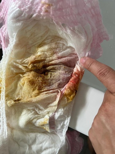 Blood in Diaper