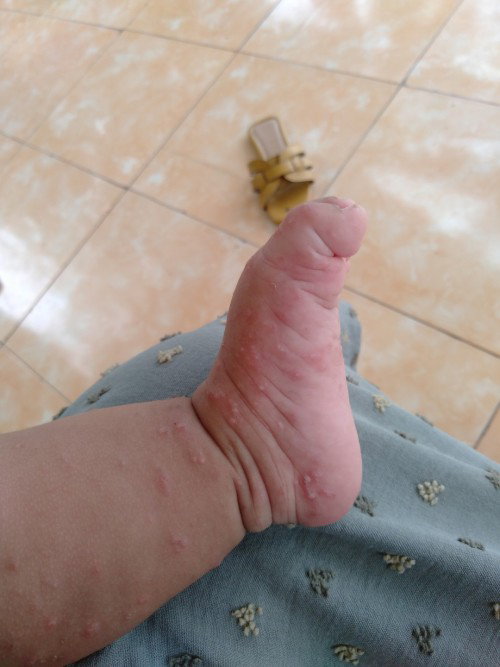Kaki bayi beruntusan