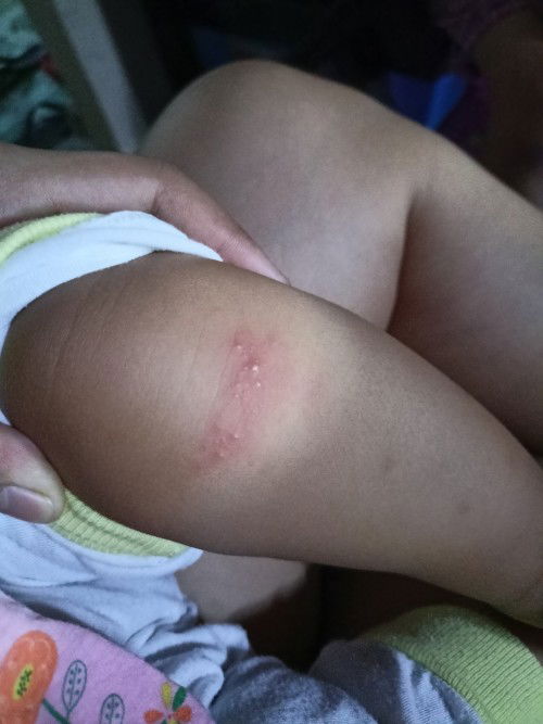 Magandang hapon mga mami anu po kaya eto bigla nlng nagkaron si lo na ganyan sana may sumagot😊 TIA