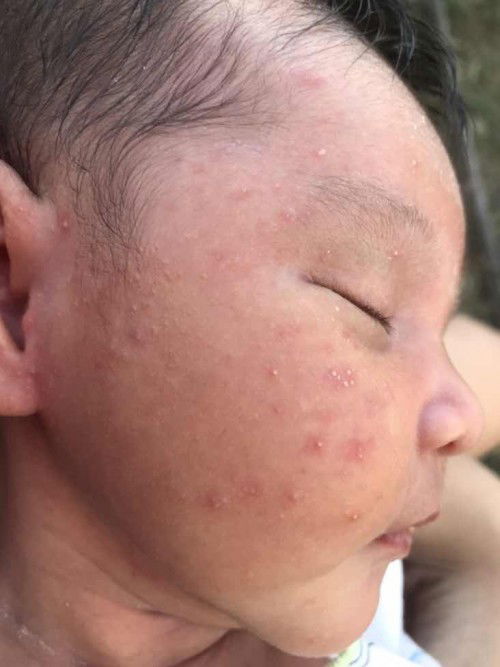 น้องเป็นสิวแบบนี้เกิดจากอะไรคะ