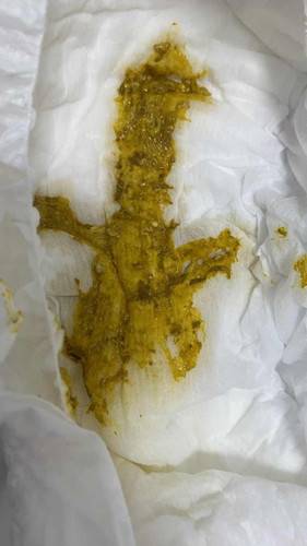 อึเด็กทารกแบบนี้ผิดปกติมั้ย