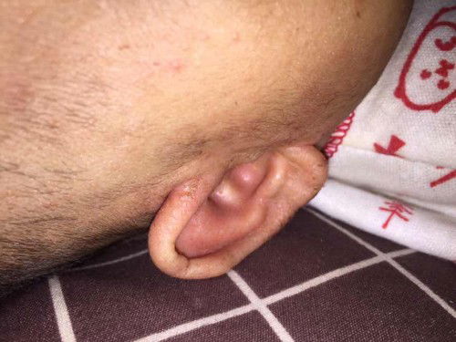 Telinga bayi berkerak, bau dan lecet kemerahan