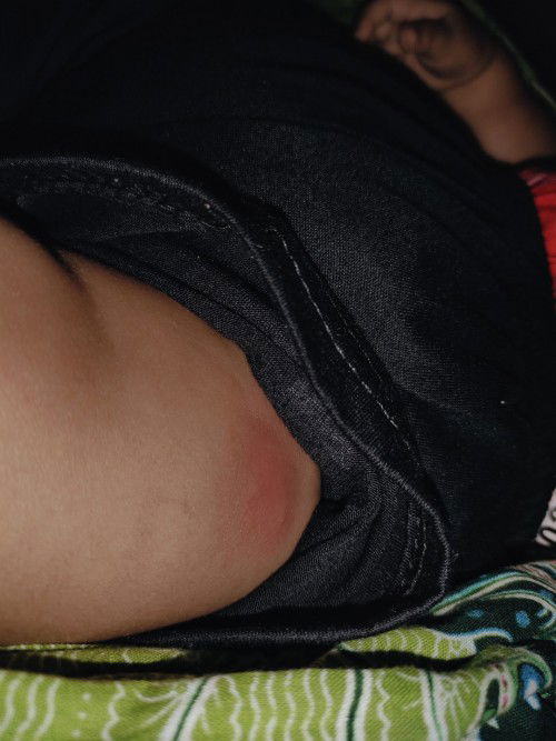 Yg tau cara ngempesin nya dong Bun abis imunisasi udah 6 hari masih keras bengkak 🥺
#seriustanya