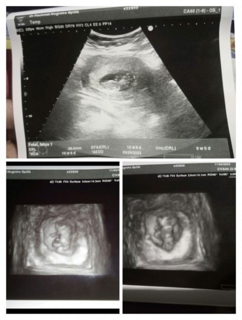 Hasil USG 10 Minggu 6 hari kok beda ya usia nya sama aplikasi saya 10 Minggu 1 hari.