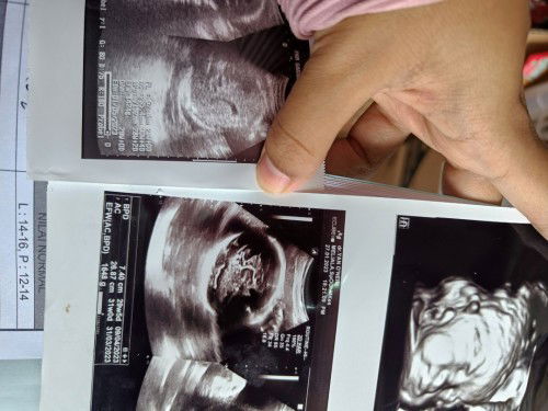 Perbedaan hasil USG puskesmas dan rumah sakit