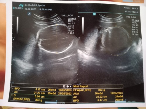 BB janin dan posisi janin