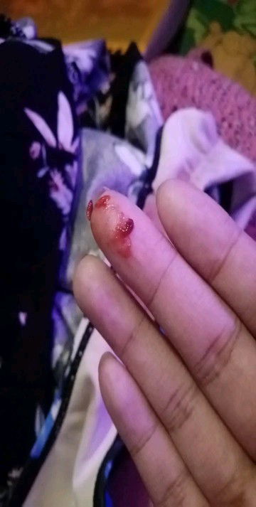 Kakauwi kolang galing followup CU ko, tapos pag cr ko nakita ko ito sa underwear ko. Slight blood