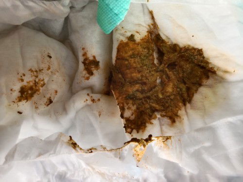 ขอสอบถามแม่ๆคะ ภาพอาจไม่เหมาะสมหน่อยนะคะ  น้องถ่ายมาแบบนี้ผิดปรกติไหมคะ