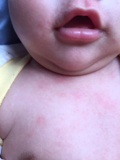 Bé bị mẩn ngứa