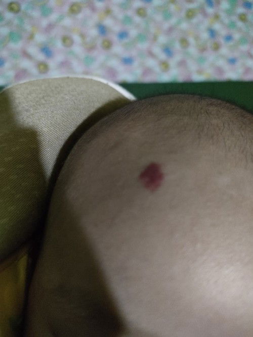 Hemangioma bayi