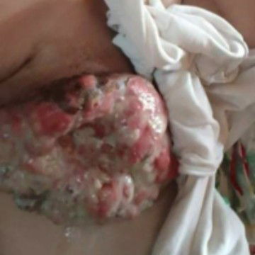 Lumalang Breast Abscess 😭