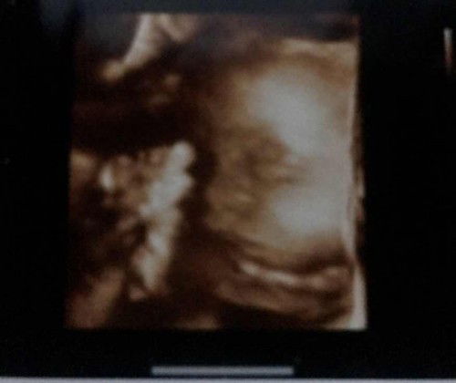 ซาวด์4D27w+5สายสะดือพันคอน้อง