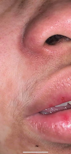 Dark spot sa muka na mahapdi pa help