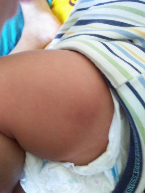 Bekas suntikan imunisasi DPT 2 jadi bengkak dan merah