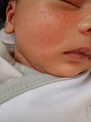 Normal lang po ba ito sa baby natatakot po kase ako dumadani po pati kabila cheeks po nya meron