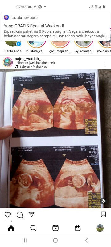 Sharing dong bun hamil kembar identik (1plasenta)