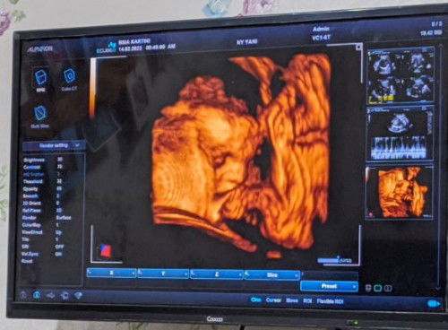 Bb janin 28 week kurang