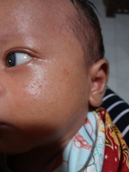 Bayi saya umur 21 hari tapi kulitnya bintik² merah ..minta saran obat nya apa ya?