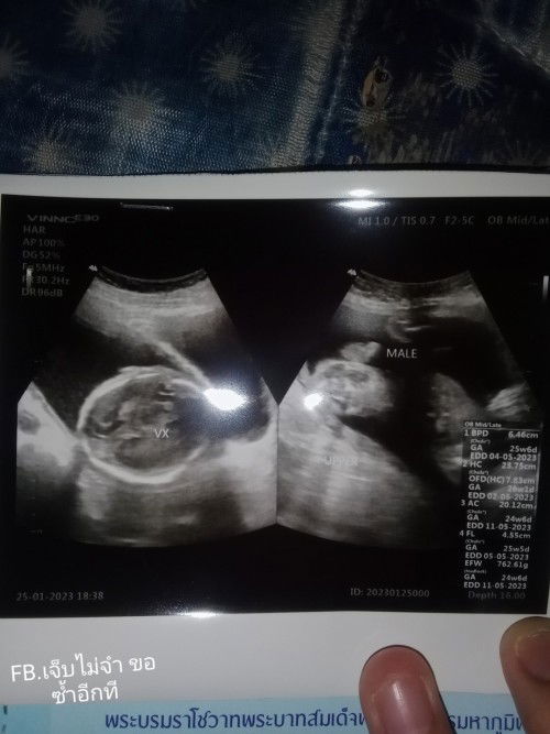 การนับอายุครรภ์