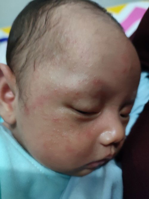 Bruntusan merah di wajah