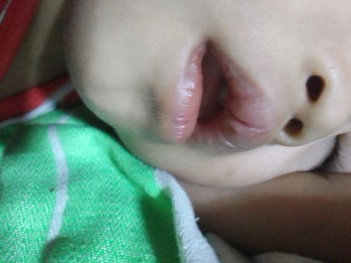 Anu Po pwede Gawin gamot o ipahid sa labi Ng baby ko nagsusugat na Po at malalim  nagdudugo den Po