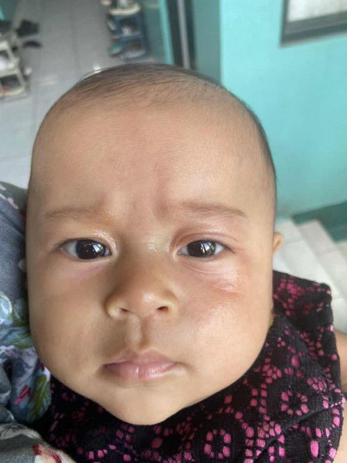 ruam/gatal di kelopak mata