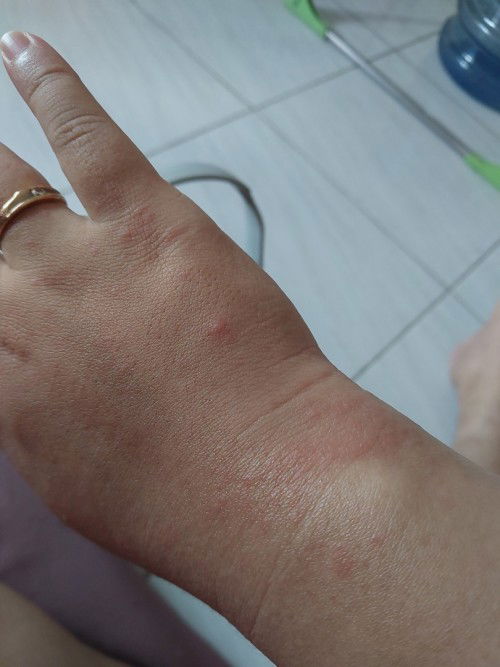 Gatal bintik merah seluruh tubuh