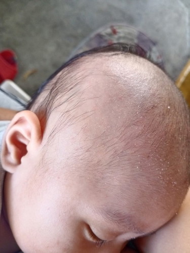 Going 3 months , nagpupuknat po buhok ng baby ko