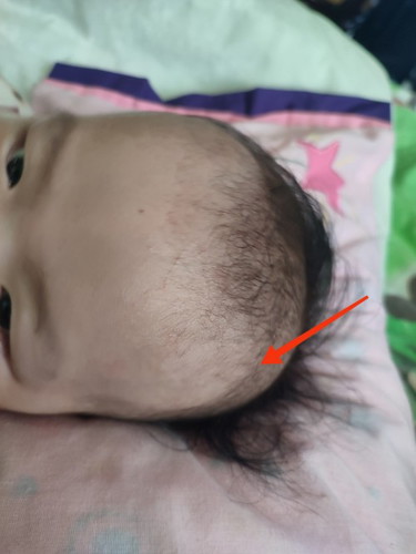 Nakaumbok na parang buto or bukol sa ulo ni baby