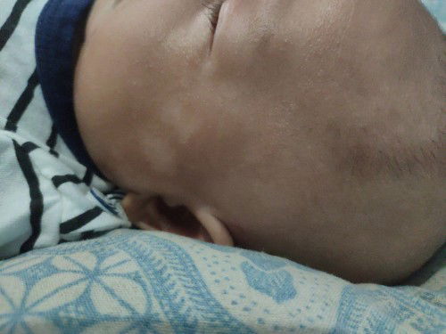 Obat dan penanganan untuk bercak putih putih di pipi bayi 2bulan