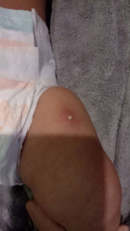 Bekas imunisasi DPT keluar nanah dan seperti bisul