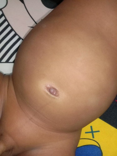 สะดืออักเสบ