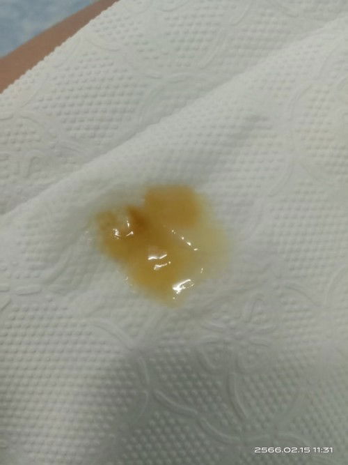 ตกขาวสีเหลือง