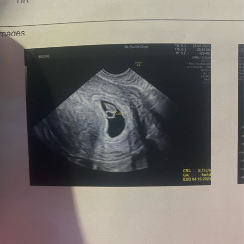 6w5dตอนนี้กังวลมากเลยค่ะ เคียด