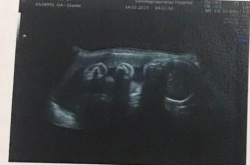 32weekลูกน้อยคุณเเม่หนักเท่าไรกันบ้างคะ