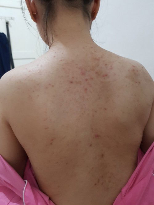 Hamil 18 weeks jerawat punggung dan dada