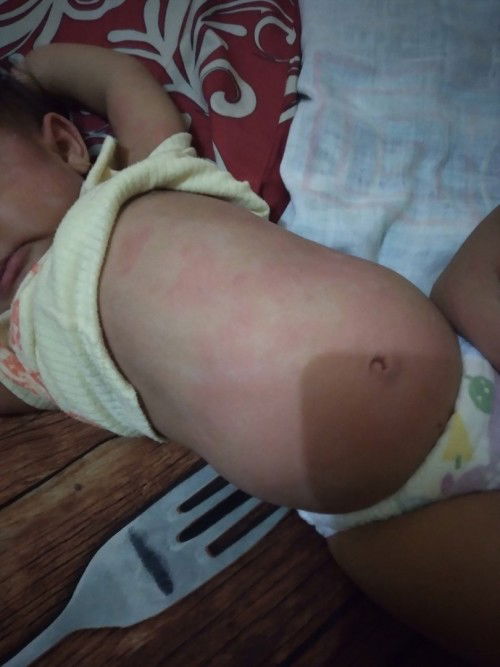 Apakah biduran pada bayi 11 bulan bisa sembuh? Dan obatnya apa?