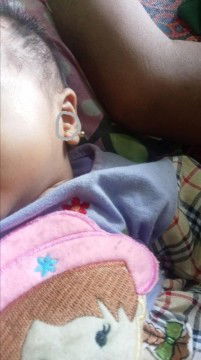 Cara ampuh menghilangkan kutil pada bayi 2 bulan