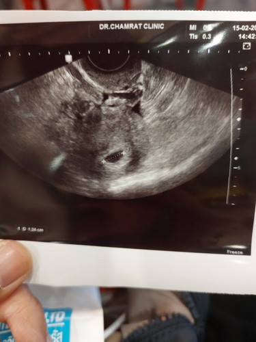 แม่ๆเจอลูกตอนกี่วีคค่ะ เราพบแต่ถุงไม่พบเด็ก 8 วีคแล้ว กลัวท้องลมมากเลยค่ะ