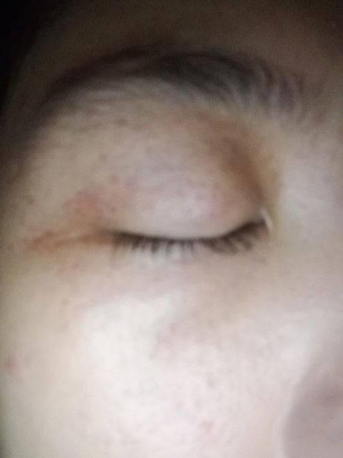 Muncul bercak merah di sekitar mata