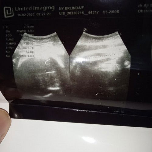 Galau dengan hasil USG