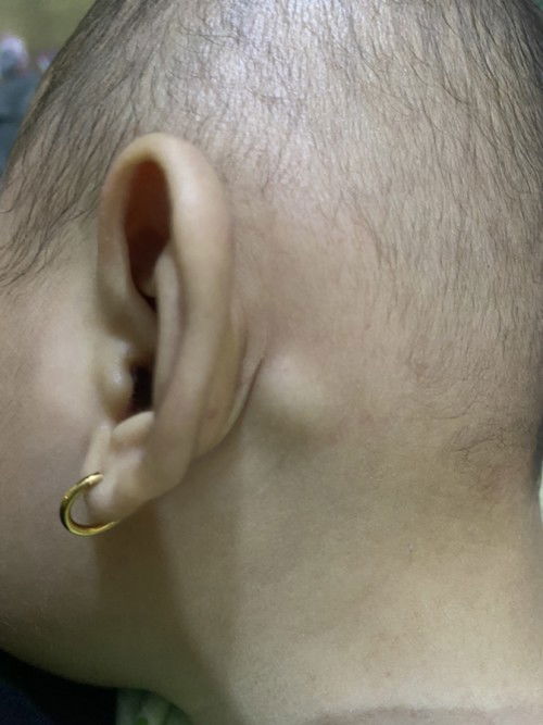 Benjolan disebelah telinga