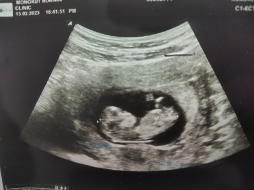 เดาเพศลูก ช หรือ ญ?