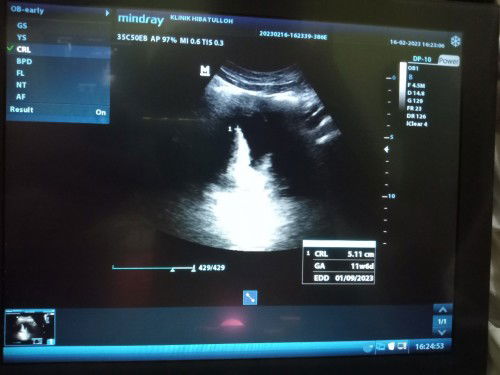 Bingung dg hasil usg