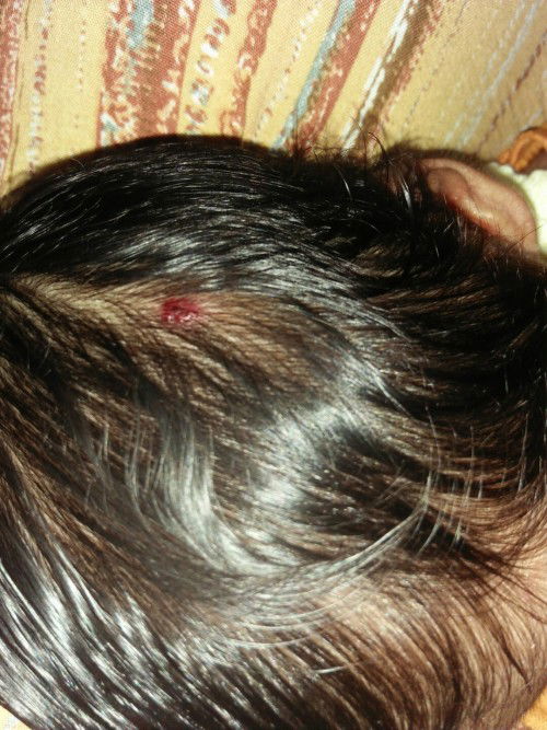 Bercak merah di kepala bayi