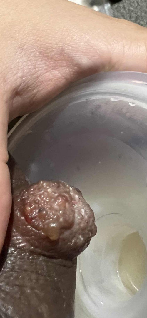 HELP PLEASE! Advice for Nipple Blisters