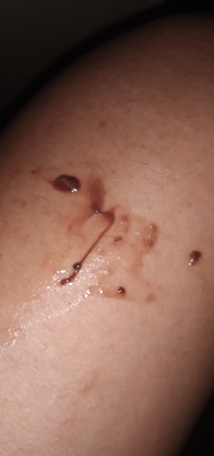 อยากสอบถามแม่ท่านใดมีเลือดออกบ้างค่ะตอนนีตั้งครรภ์11วีค