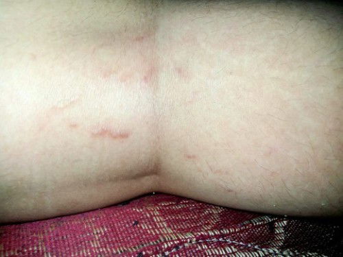 Assalamualaikum bun,mau tanya ini tuh termasuk Stretch Mark bukan yaa,tapi ini di bagian betis?