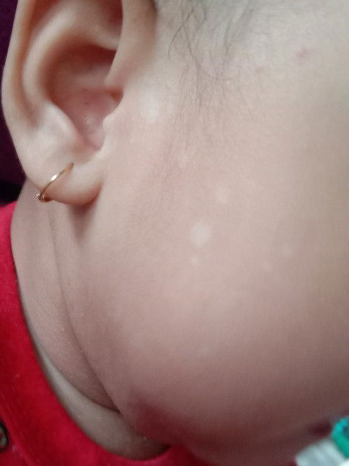 Bintik putih kaya panu